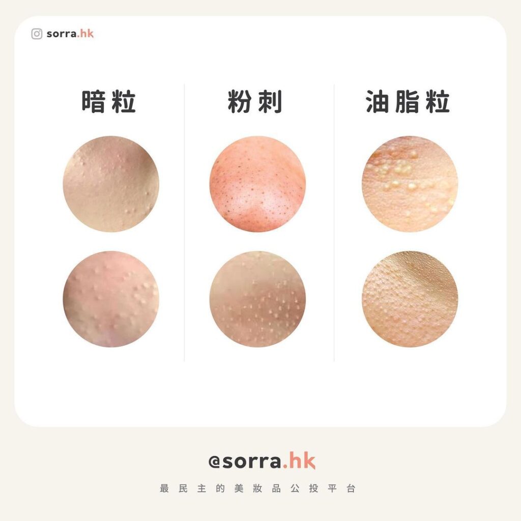 暗粒 vs 粉刺 vs 油脂粒比較