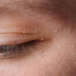 【油脂粒】5 個壞習慣易生油脂粒！教你去油脂粒方法！