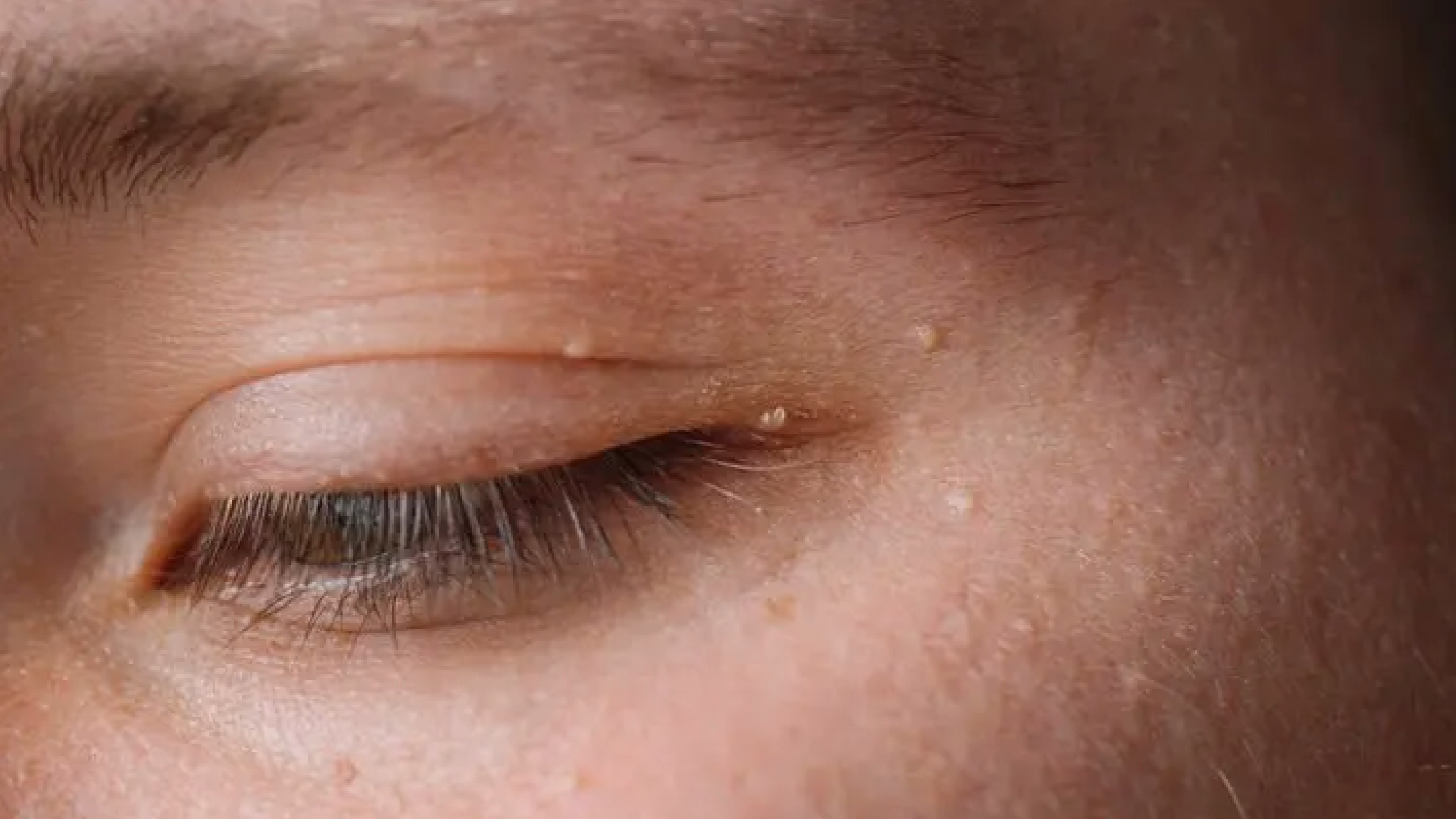 【油脂粒】5 個壞習慣易生油脂粒！教你去油脂粒方法！