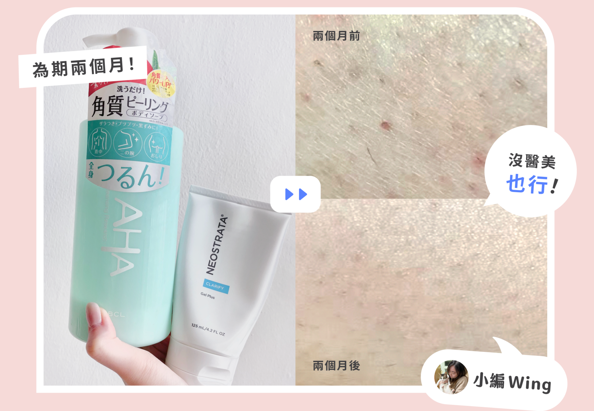 【毛囊角化】會好嗎?了解原因及改善方法