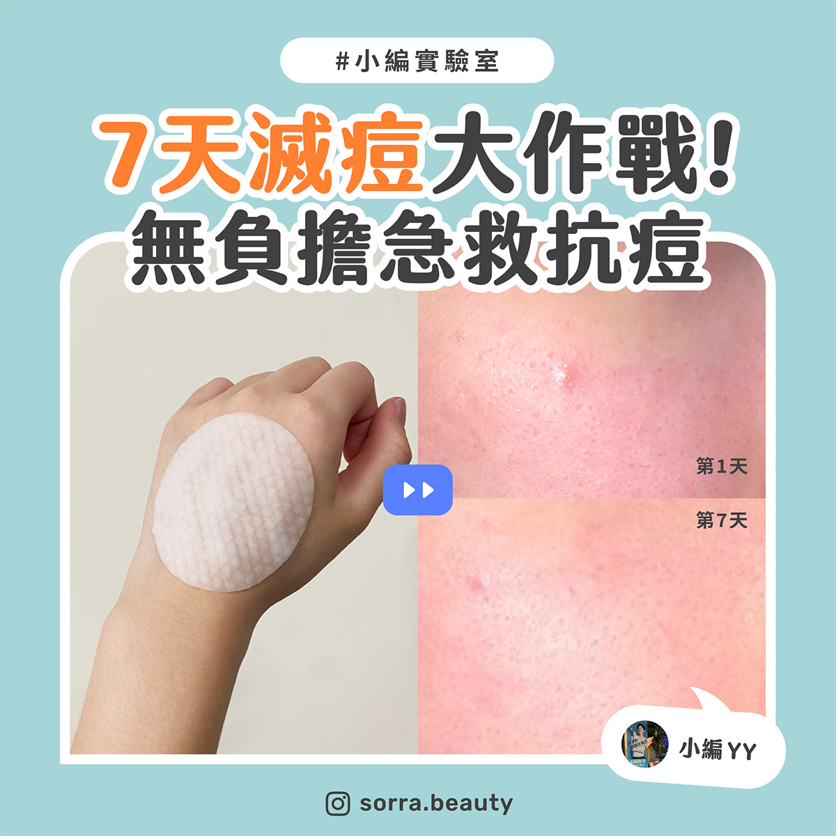 【小編實驗室】7天滅痘大作戰！無負擔急救抗痘！