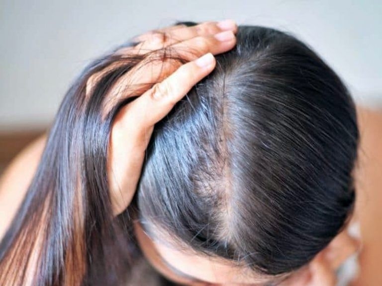 改善脫髮