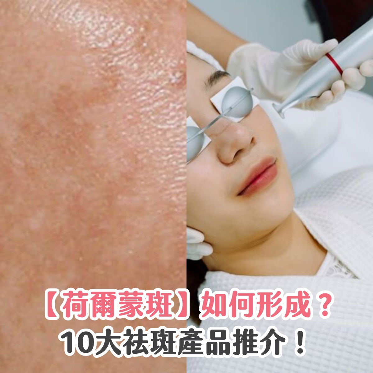 【荷爾蒙斑】如何形成？10大祛斑產品推介！