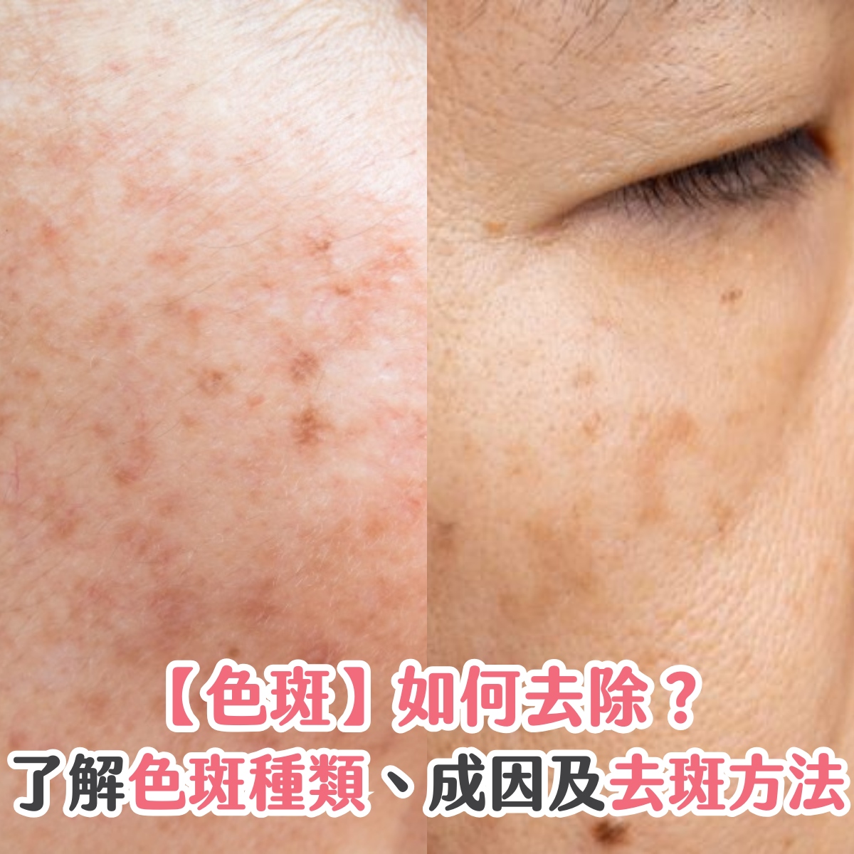 【色斑】如何去除？了解色斑種類、成因及去斑方法