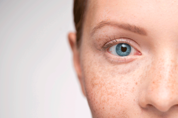 如何分辨雀斑？
