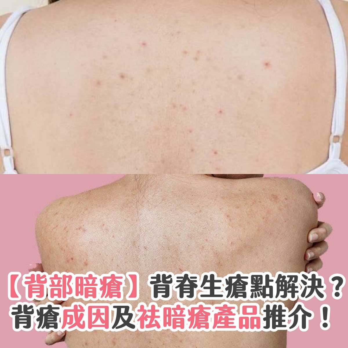 【背部暗瘡】背脊生瘡點解決？背瘡成因及袪暗瘡產品推介！