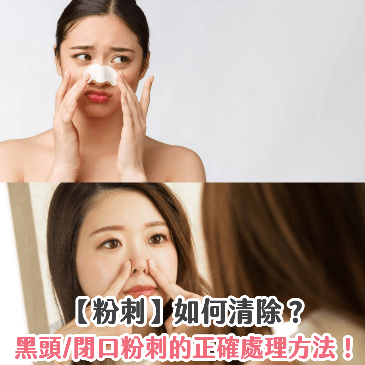 【粉刺】如何清除？黑頭/閉口粉刺的正確處理方法！