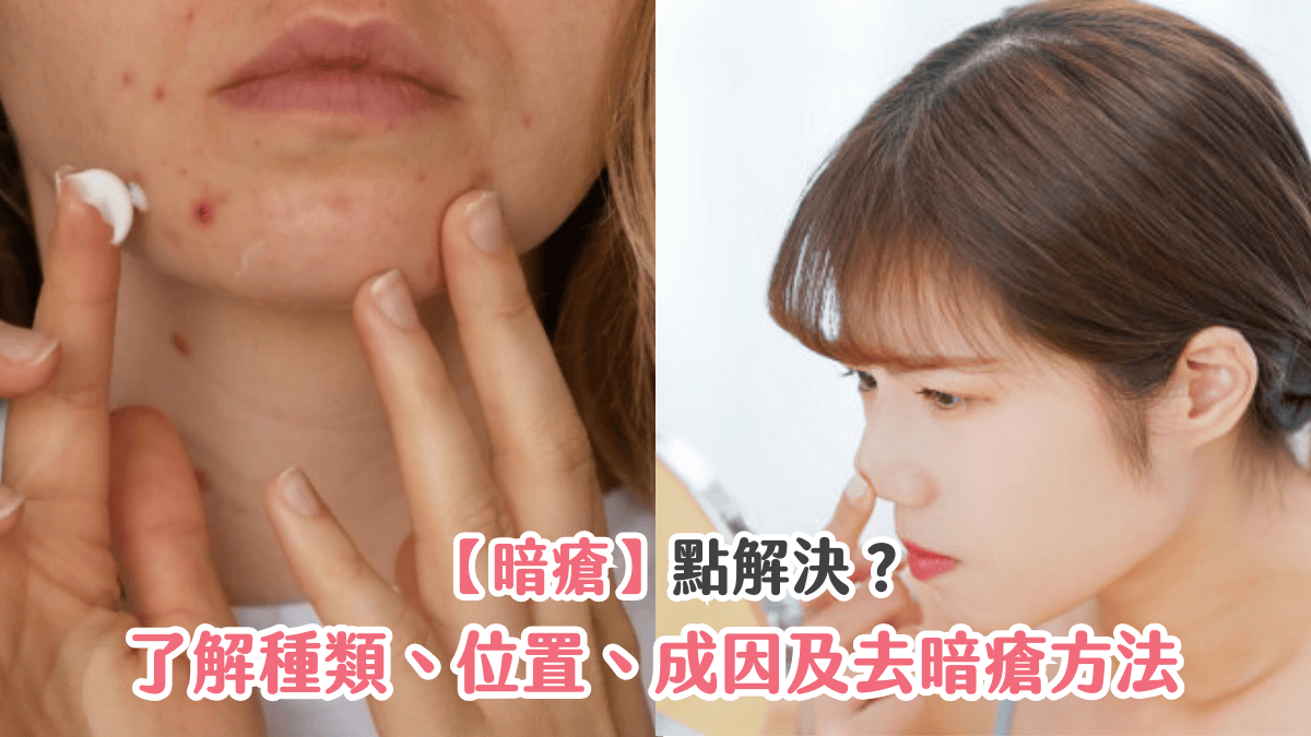【暗瘡】點解決？了解種類、位置、成因及去暗瘡方法