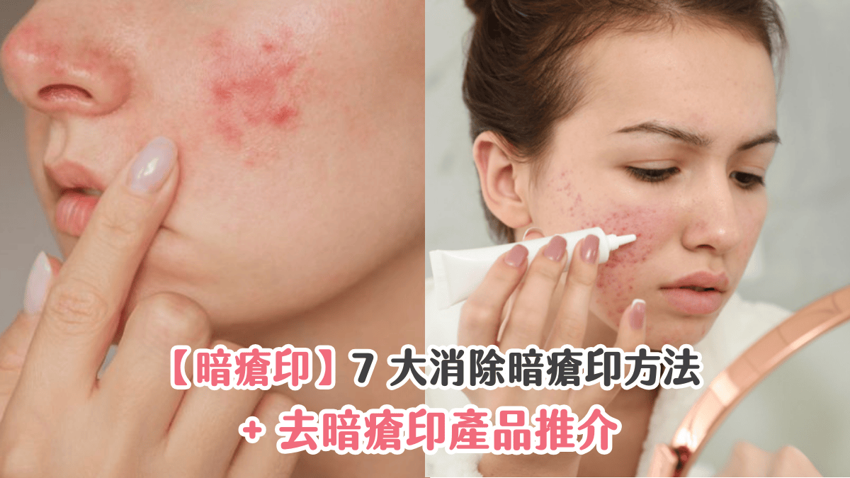 【暗瘡印】7 大消除暗瘡印方法 + 去暗瘡印產品推介 