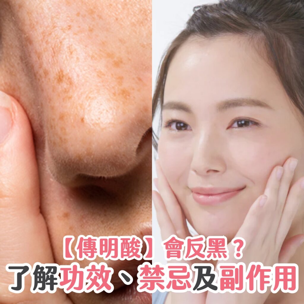 【傳明酸】會反黑？了解功效、禁忌及副作用