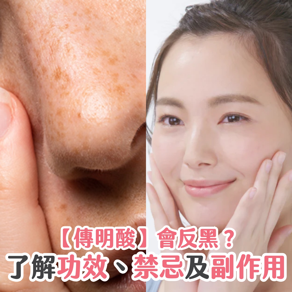 【傳明酸】會反黑？了解功效、禁忌及副作用