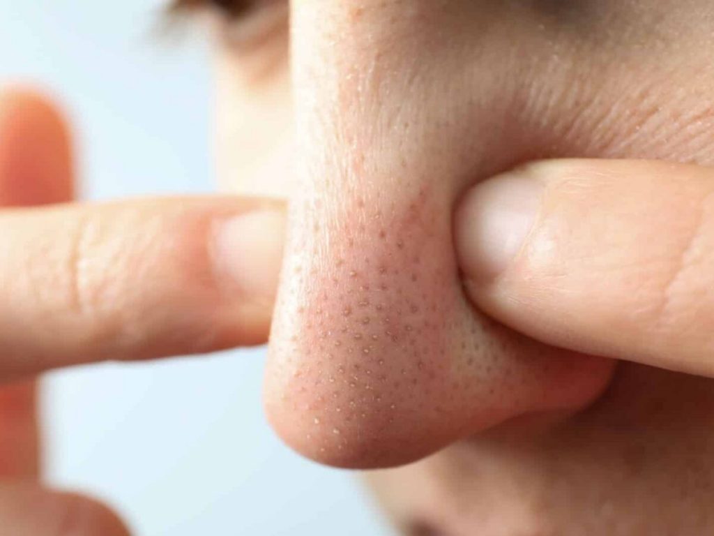 毛孔粗大的原因