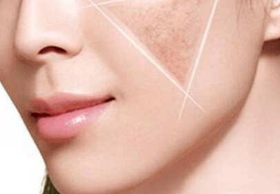 色斑和膚色不均