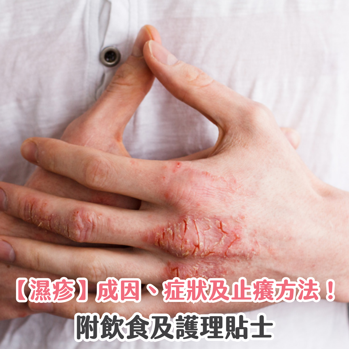 【濕疹】成因、症狀及止癢方法！附飲食及護理貼士