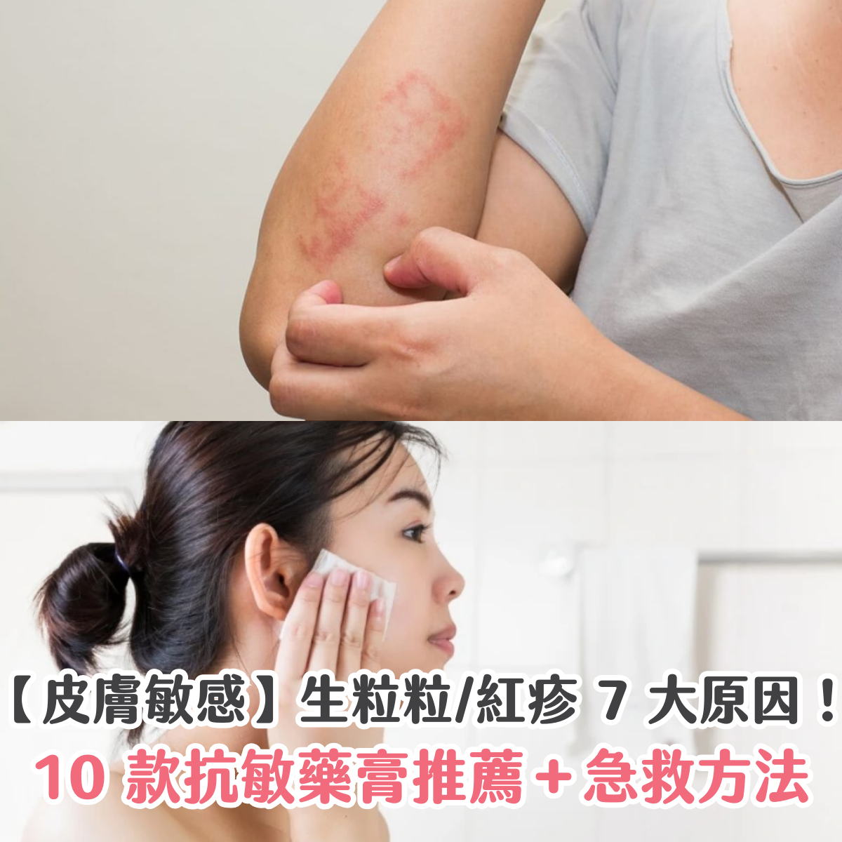 【皮膚敏感】生粒粒/紅疹 7 大原因！10 款抗敏藥膏推薦＋急救方法