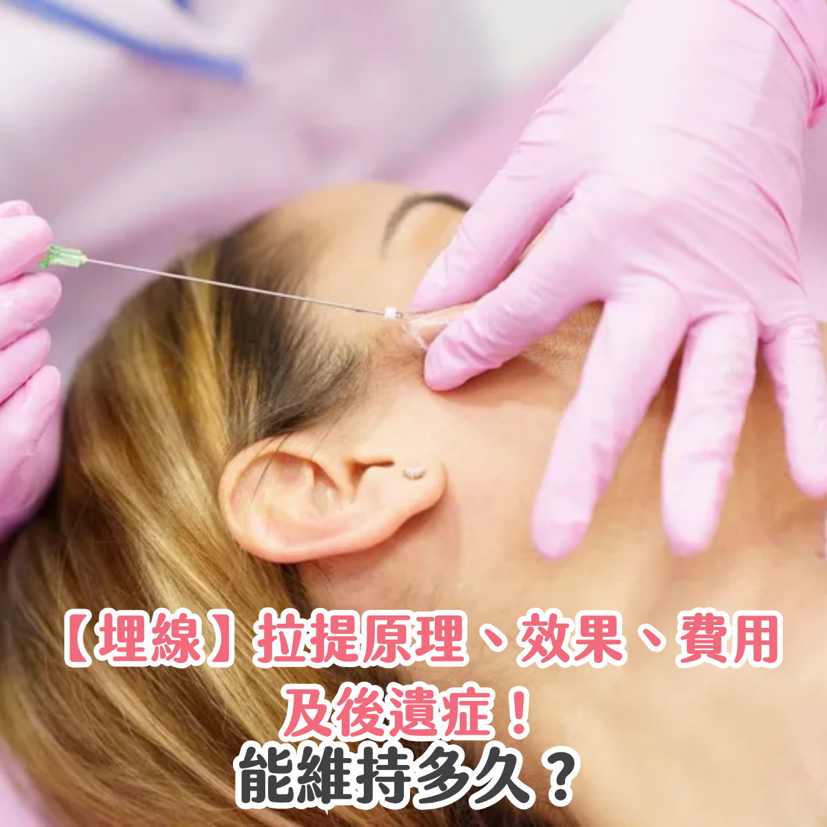  【埋線】拉提原理、效果、費用及後遺症！能維持多久？