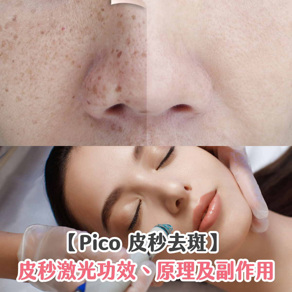 【Pico 皮秒去斑】皮秒激光功效、原理及副作用