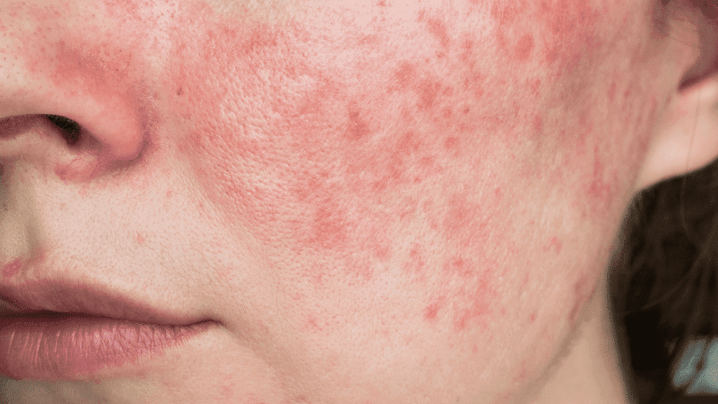 刺激紅腫、刺痛灼燒