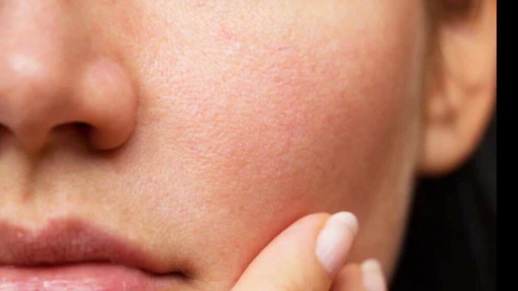 外用A酸的副作用