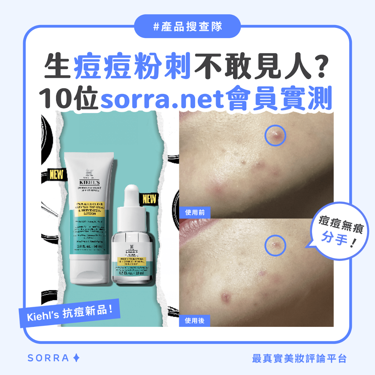 受保護的內容: 【#sorra產品搜查隊】生痘痘粉刺不敢見人？10位sorra.net會員實測！