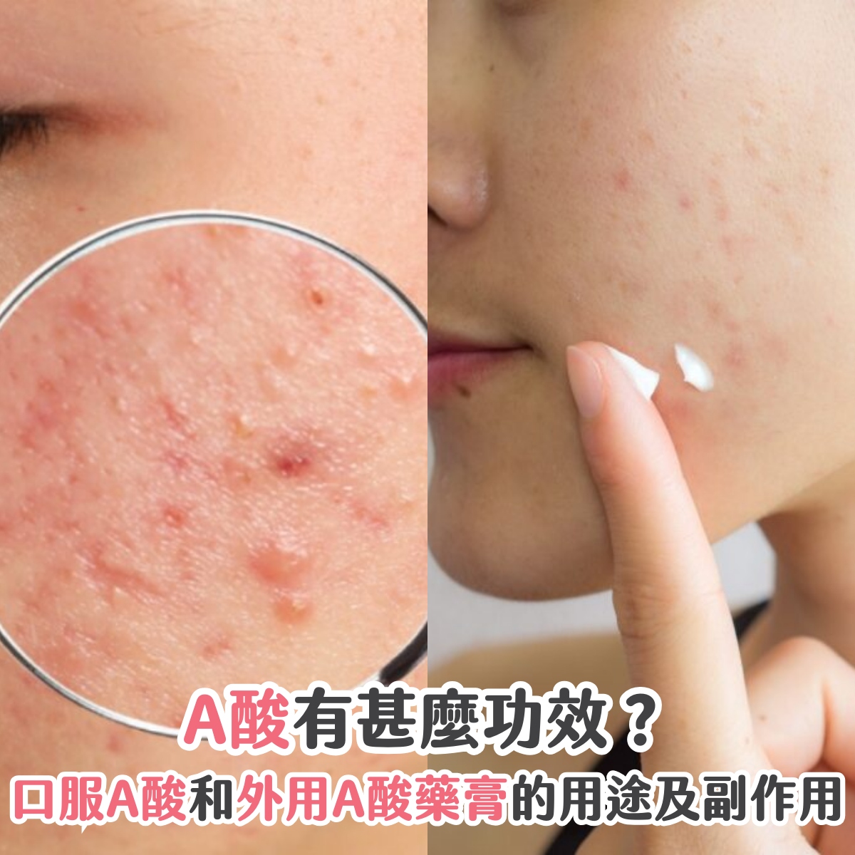 【A酸】有甚麼功效?口服A酸和外用A酸藥膏的用途及副作用