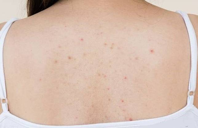 背部暗瘡的特徵