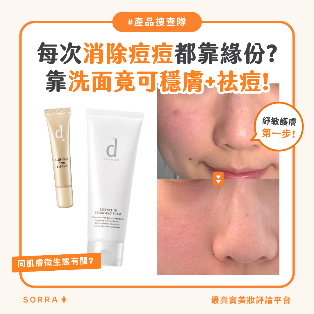 【#sorra產品搜查隊】每次消除痘痘都靠緣份？靠洗面竟可穩膚+祛痘！