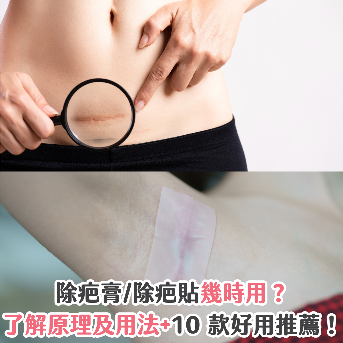 除疤膏/除疤貼幾時用？了解原理及用法 + 10 款好用推薦！