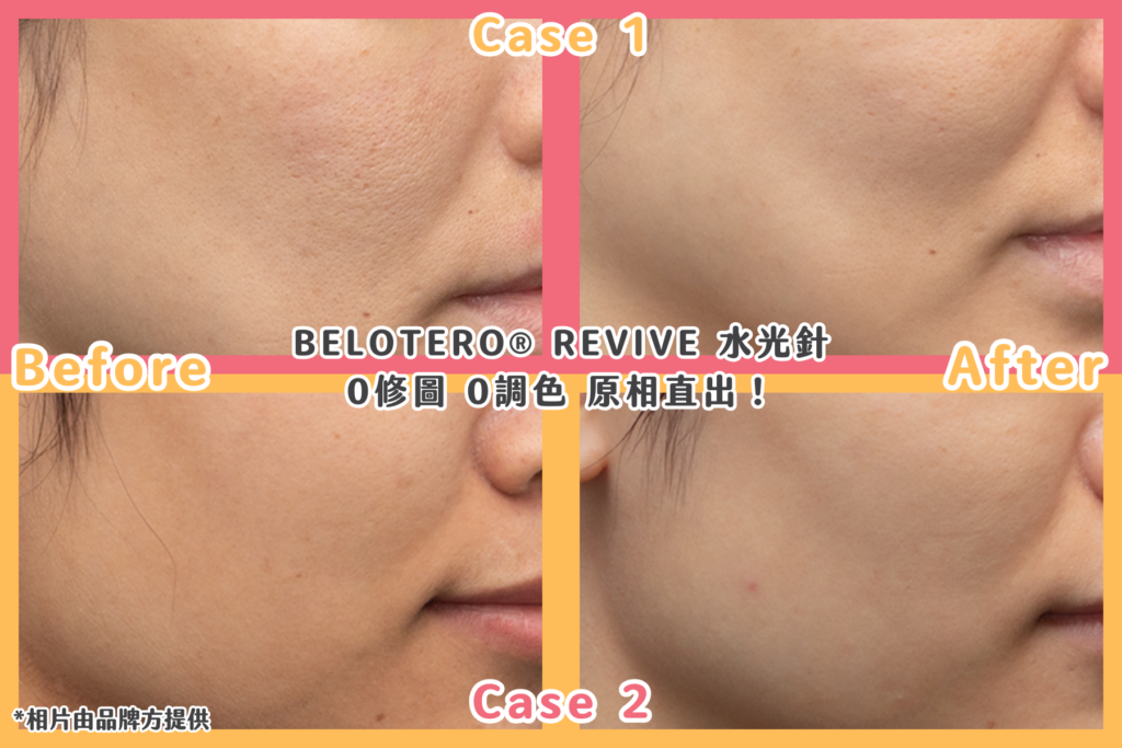 面對肌膚乾燥暗啞,不少人都會選擇醫美療程為肌膚補水保濕。市面上大部份水光針只含透明質酸,但忽略了同樣天然的保濕擔當—— 甘油!最近 Threads、DCard 大熱 BELOTERO® REVIVE 水光針好評不斷。保濕效果加乘的秘密,就藏在「甘油 x 透明質酸」獨有保濕鎖水配方裡!