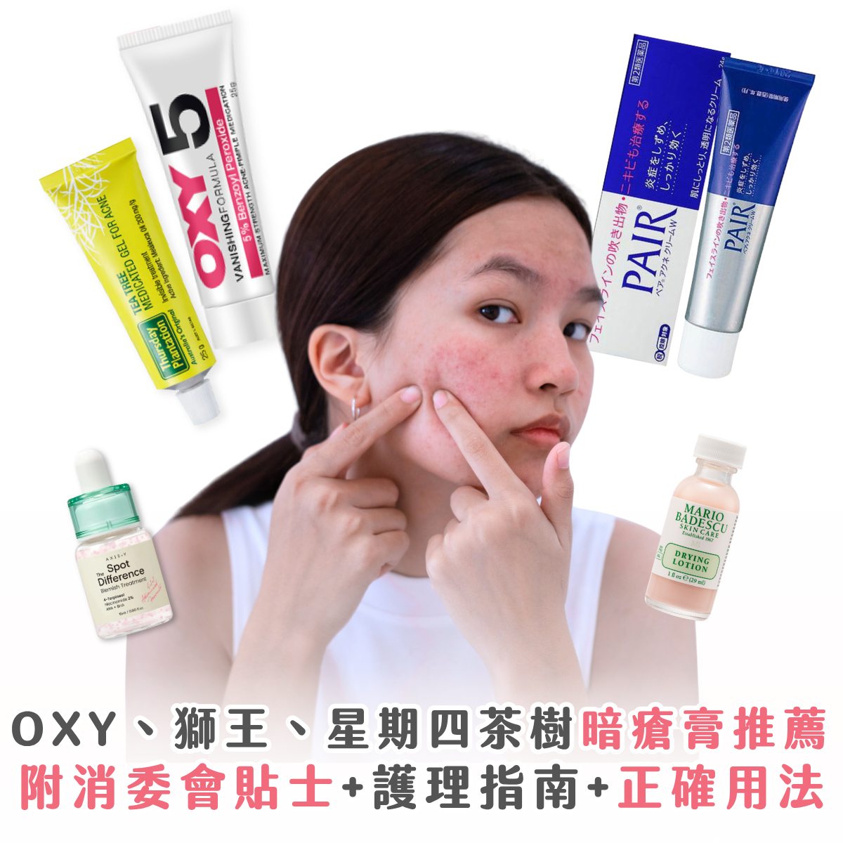 5 款暗瘡膏推薦：OXY、獅王、星期四茶樹評價 附消委會貼士 + 正確用法